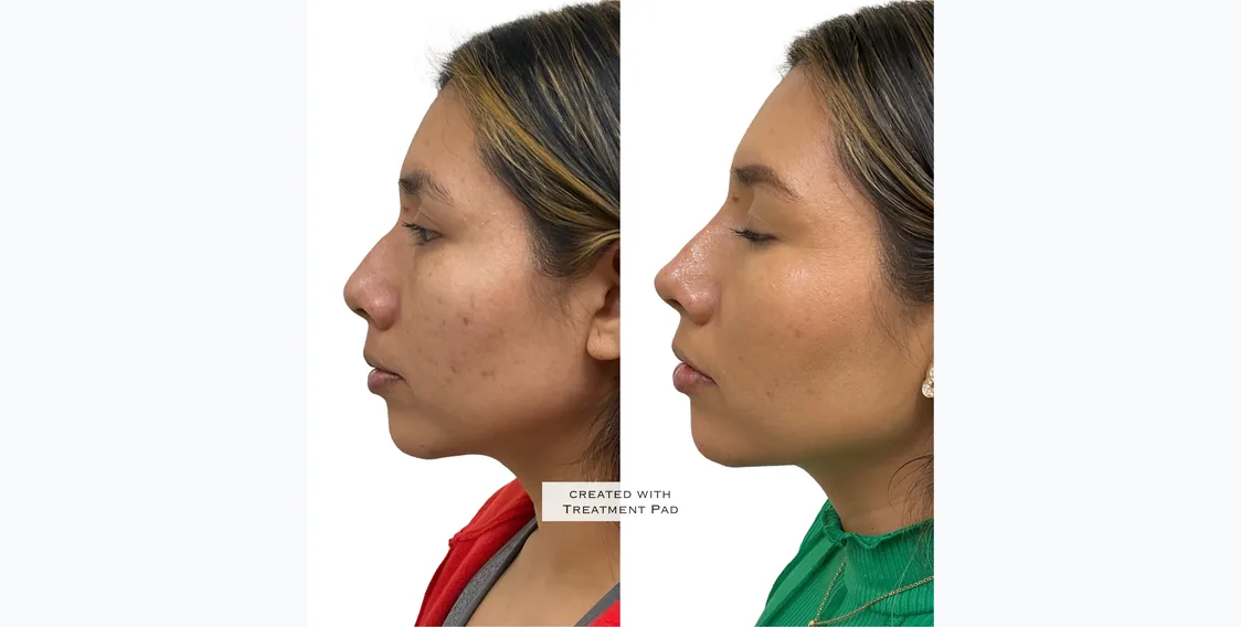 Jawline Filler